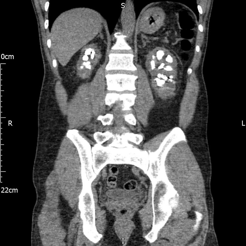 Bilateral medullary nephrocalcinosis with ureteric calculi (Radiopaedia 71269-81569 Coronal non-contrast 48).jpg