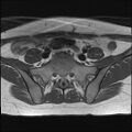 Bilateral ovarian endometriomas (Radiopaedia 87085-103347 Axial T1 2).jpg