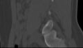 Bilateral pars defect (Radiopaedia 26691-26846 Sagittal bone window 48).jpg