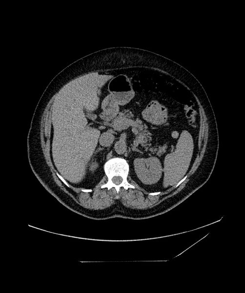 File:Bilateral sporadic synchronous clear cell renal cell carcinoma (Radiopaedia 85035-100573 Axial non-contrast 44).jpg