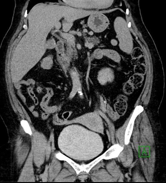 File:Bilateral sporadic synchronous clear cell renal cell carcinoma (Radiopaedia 85035-100575 I 21).jpg