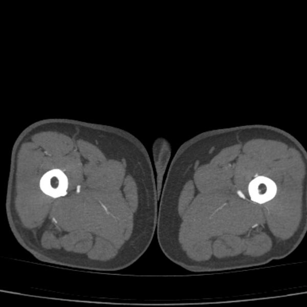File:Bilateral superficial femoral arterial occlusion (Radiopaedia 25682-25857 A 38).jpg