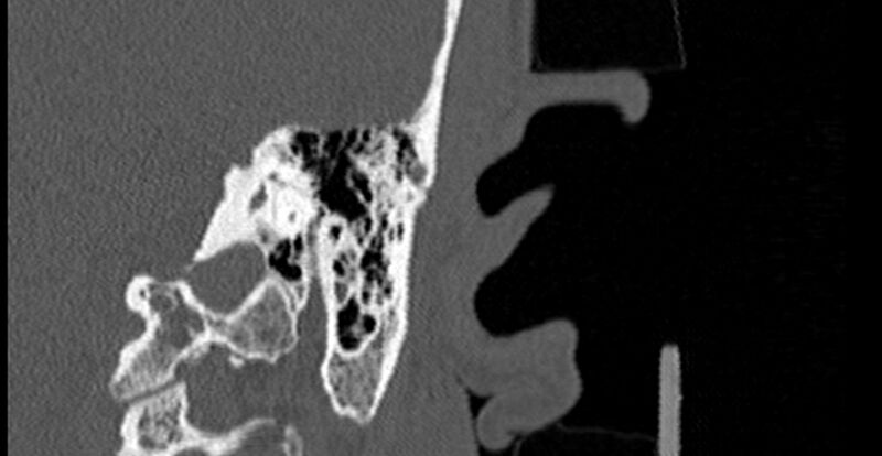 File:Bilateral temporal bone fractures (Radiopaedia 29482-29970 B 62).jpg