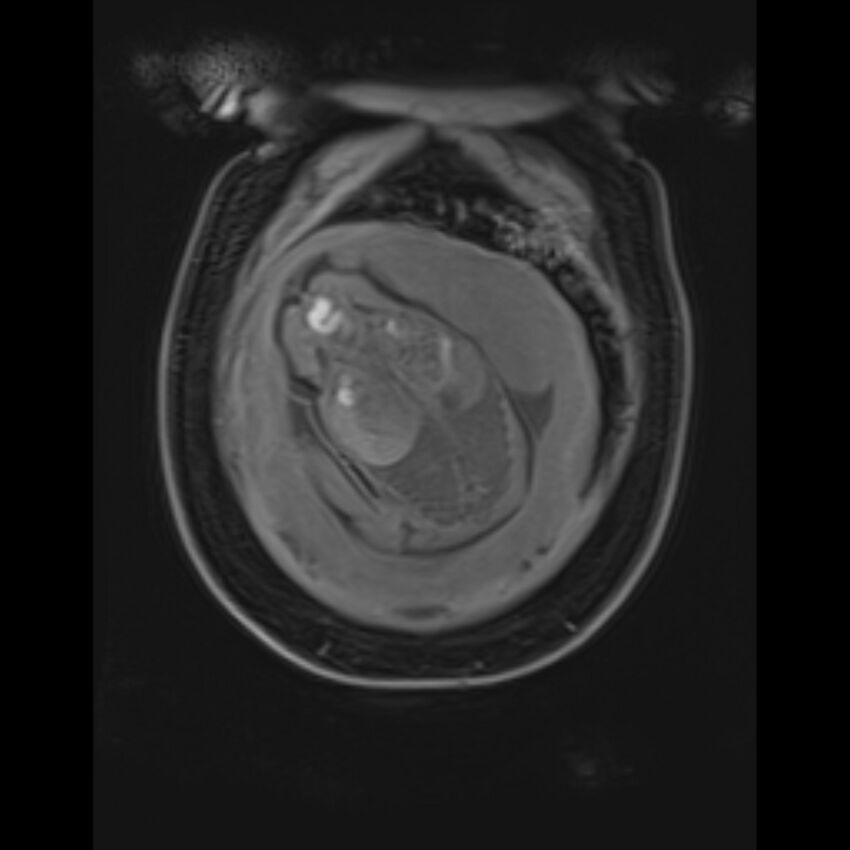 Bilobed placenta accreta (Radiopaedia 69648-79591 Coronal T1 vibe 31).jpg