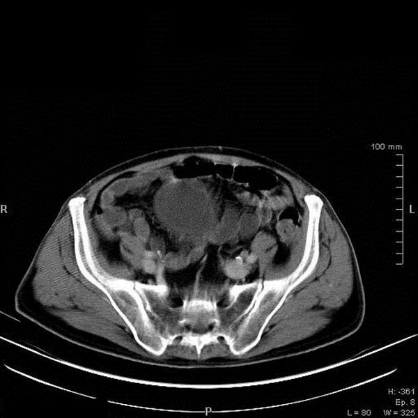 File:Bladder squamous cell carcinoma (Radiopaedia 14130-13984 B 2).jpg