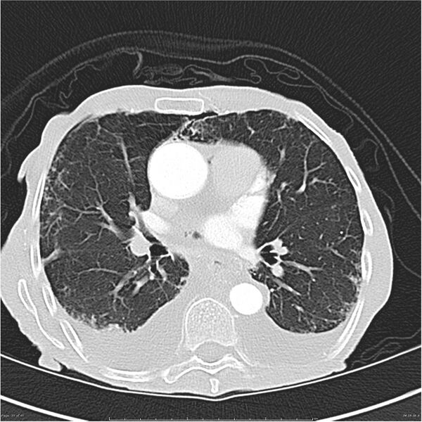 File:Boerhaave syndrome (Radiopaedia 26240-26362 Axial lung window 25).jpg