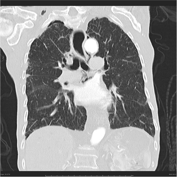 File:Boerhaave syndrome (Radiopaedia 26240-26362 Coronal lung window 18).jpg
