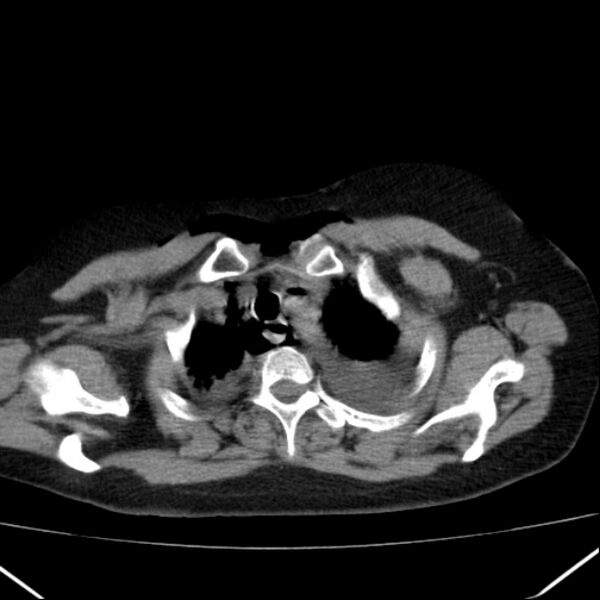 File:Boerhaave syndrome (Radiopaedia 45644-49799 Axial non-contrast 21).jpg