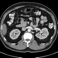 Bosniak cyst - type IV (Radiopaedia 23525-23627 renal cortical phase 19).jpg
