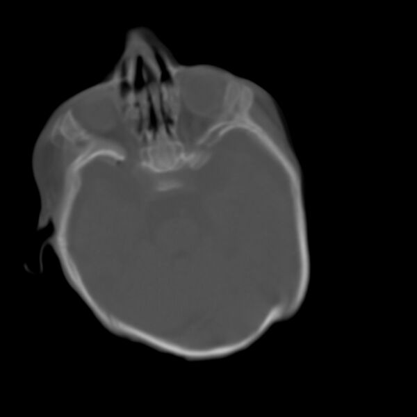 File:Brachycephaly (bi-coronal and bi-lambdoid synostosis) (Radiopaedia 55048-61413 Axial bone window 1).jpg