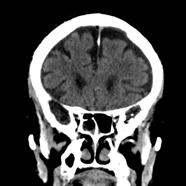File:Brain Pantopaque remnants (Radiopaedia 78403-91048 Coronal non-contrast 23).jpg