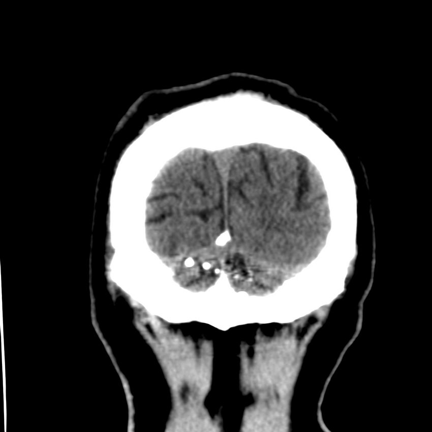 Brain Pantopaque remnants (Radiopaedia 78403-91048 Coronal non-contrast 65).jpg