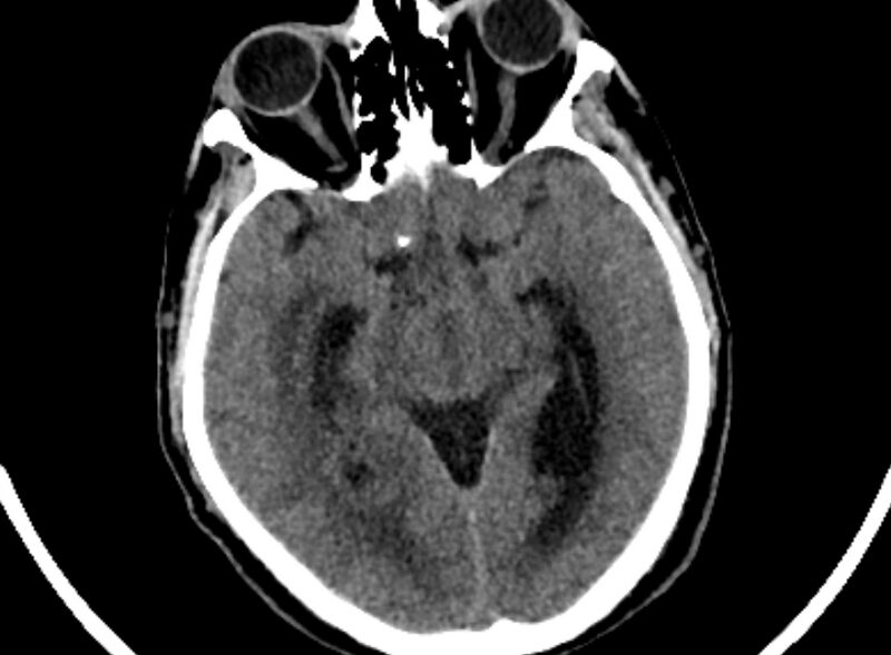 File:Brain abscess complicated by intraventricular rupture and ventriculitis (Radiopaedia 82434-96575 Axial non-contrast 24).jpg
