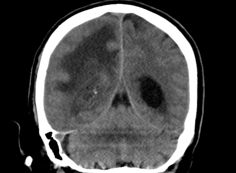 File:Brain abscess complicated by intraventricular rupture and ventriculitis (Radiopaedia 82434-96575 Coronal non-contrast 20).jpg