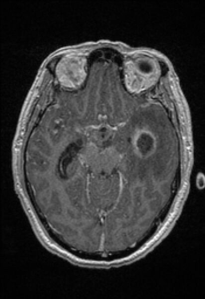 File:Brain abscess with ventriculitis (Radiopaedia 85703-101495 Axial T1 C+ 74).jpg