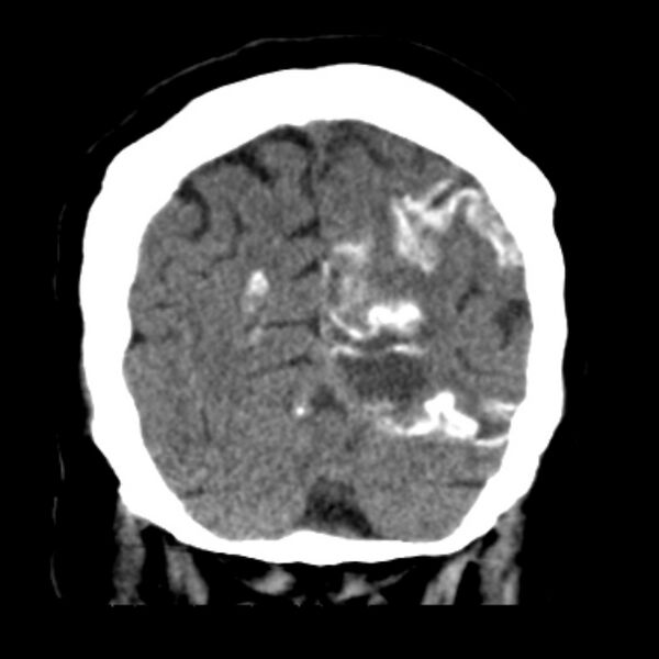 File:Brain cortical laminar necrosis (Radiopaedia 25822-25971 C 45).jpg
