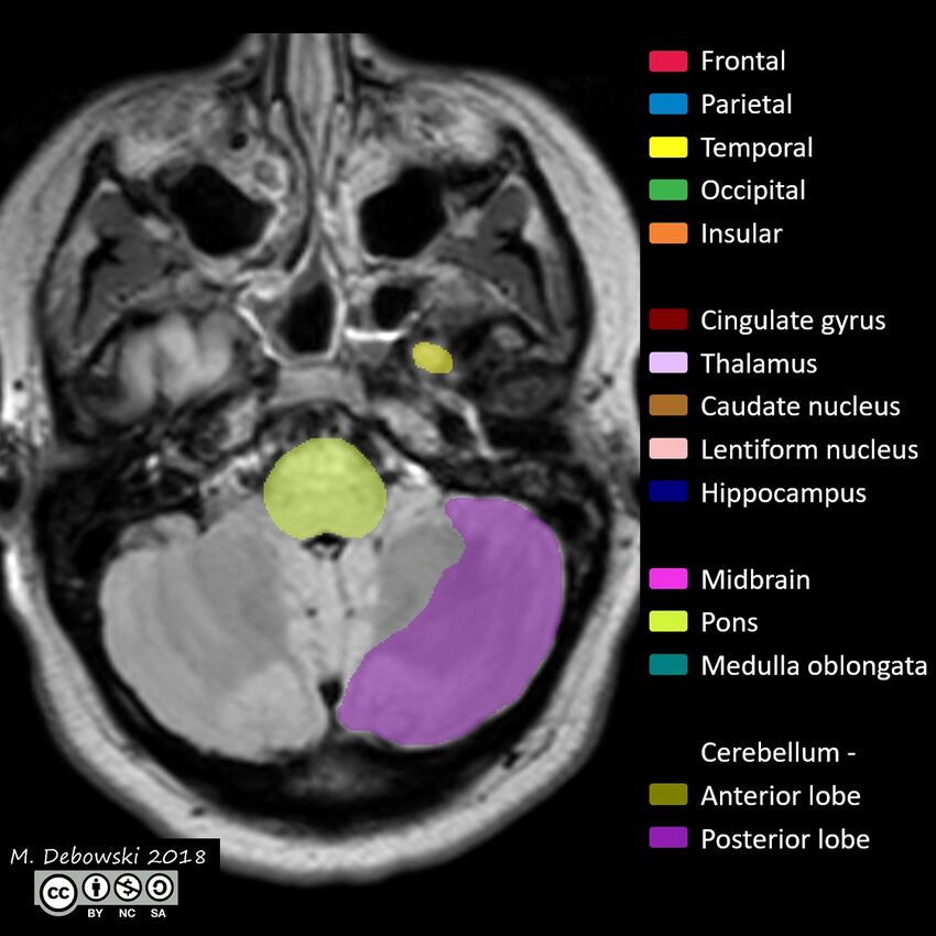 Brain lobes - annotated MRI (Radiopaedia 61691-69700 Axial 63).JPG