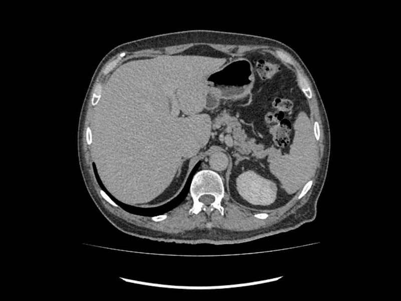 File:Brain metastases from renal cell carcinoma (Radiopaedia 42222-45328 Axial C+ delayed 12).jpg