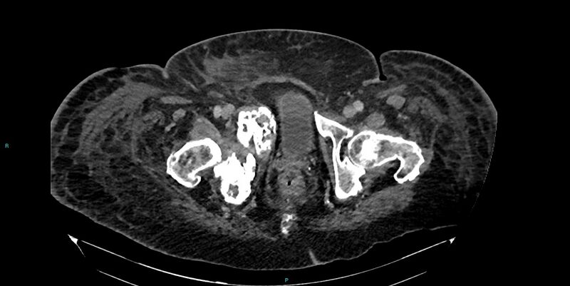 File:Breast cancer pelvic bony metastases (Radiopaedia 84470-99824 Axial bone window 63).jpg