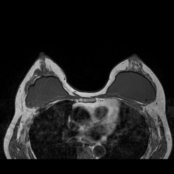 File:Breast implants - MRI (Radiopaedia 26864-27035 Axial T1 31).jpg