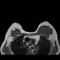 Breast implants - MRI (Radiopaedia 26864-27035 Axial T1 37).jpg