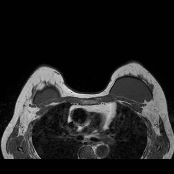 File:Breast implants - MRI (Radiopaedia 26864-27035 Axial T1 37).jpg
