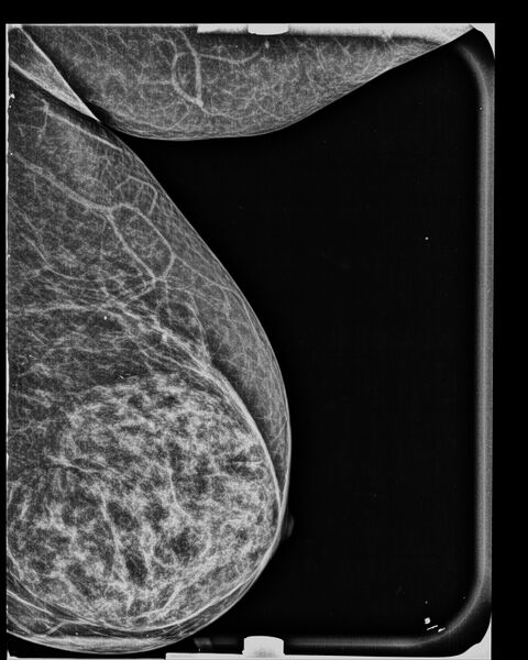 File:Breast within a breast sign of breast hamartoma (Radiopaedia 56853-63682 MLO 1).jpg