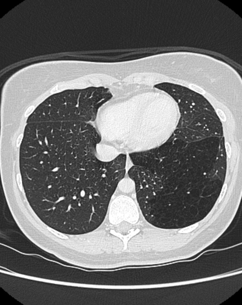 Bronchial atresia (Radiopaedia 50007-55297 Axial lung window 82).jpg