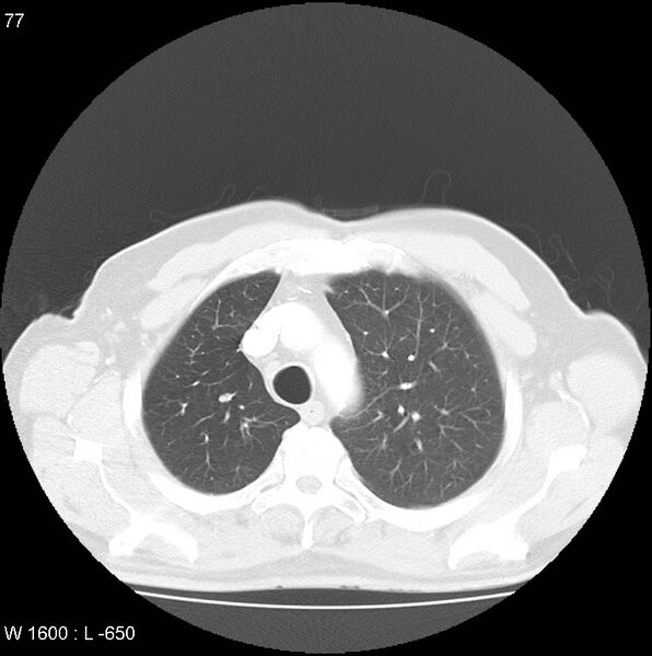 File:Bronchial carcinoid tumor with right lower lobe collapse (Radiopaedia 29060-29422 B 15).jpg