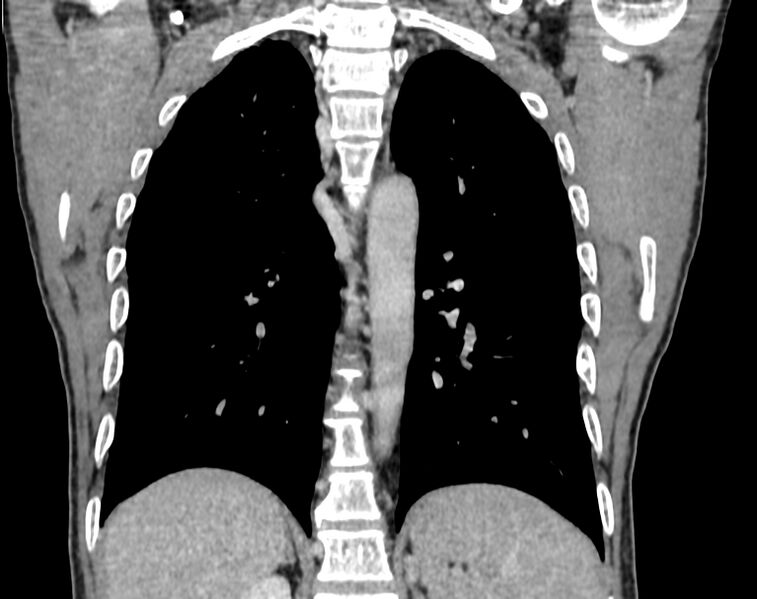 File:Bronchogenic carcinoma with superior vena cava syndrome (Radiopaedia 36497-38054 Coronal C+ delayed 80).jpg