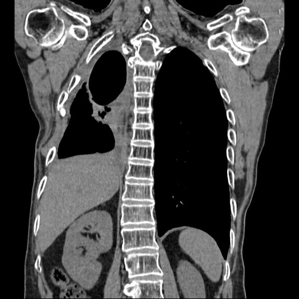 File:Bronchopleural fistula - postoperative complication (Radiopaedia 21020-20947 Coronal non-contrast 21).jpg
