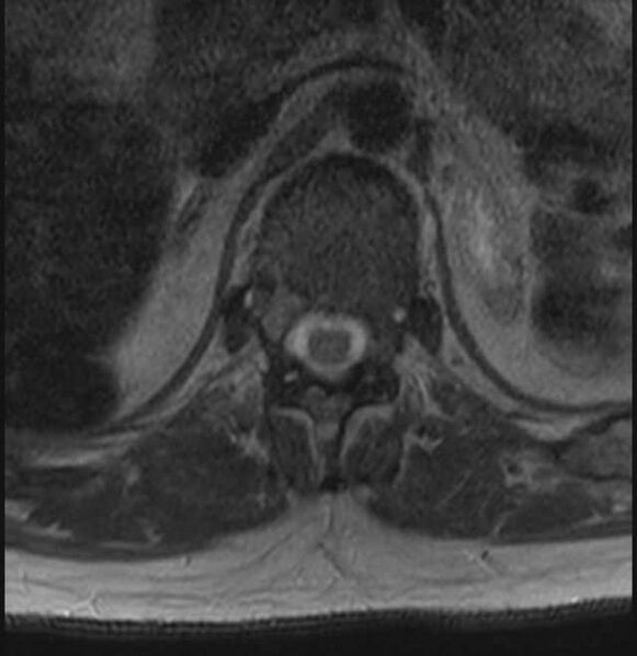 File:Brown tumors compressing the spinal cord (Radiopaedia 68442-78030 A 1).jpg
