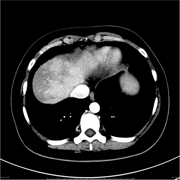 File:Budd-Chiari syndrome (Radiopaedia 27929-28177 Axial liver window 5).JPG