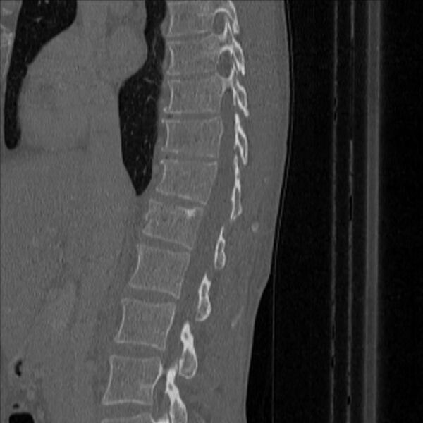 File:Bulging of paraspinal line in traumatic thoracal spinal compression fracture (Radiopaedia 29221-35872 Sagittal bone window 18).jpg