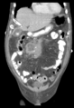 Burkitt lymphoma (Radiopaedia 39564-41874 B 20).png