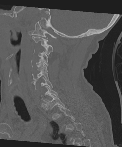 File:C2 fracture with vertebral artery dissection (Radiopaedia 37378-39199 Sagittal bone window 29).png