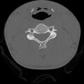C5 facet fracture (Radiopaedia 58374-65499 Axial bone window 45).jpg