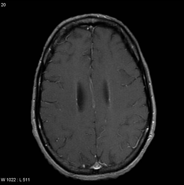 File:CMV ventriculitis and encephalitis (Radiopaedia 5416-7166 Axial T1 C+ 9).jpg