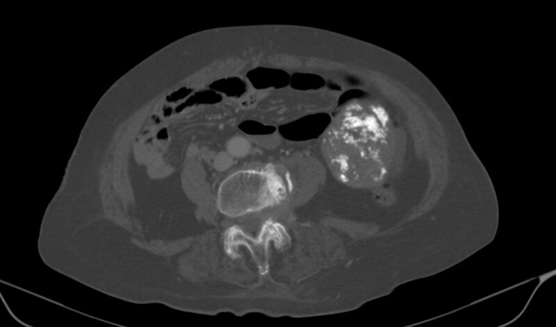 File:Calcified fibroids (Radiopaedia 20306-20228 Axial bone window 3).jpg