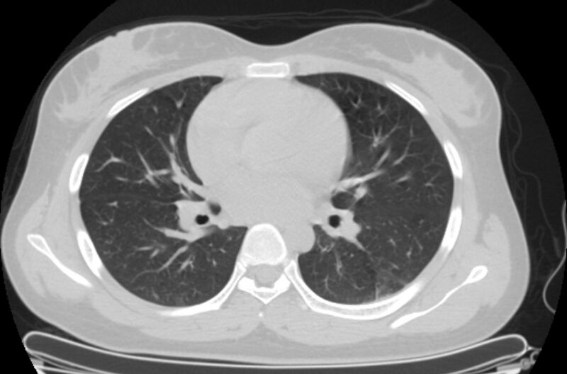 File:Cannonball metastases - uterine choriocarcinoma (Radiopaedia 70137-80173 Axial lung window 51).jpg