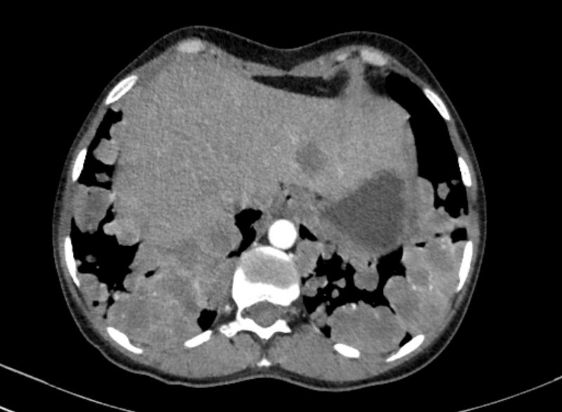 File:Cannonball metastases from breast cancer (Radiopaedia 91024-108569 A 103).jpg