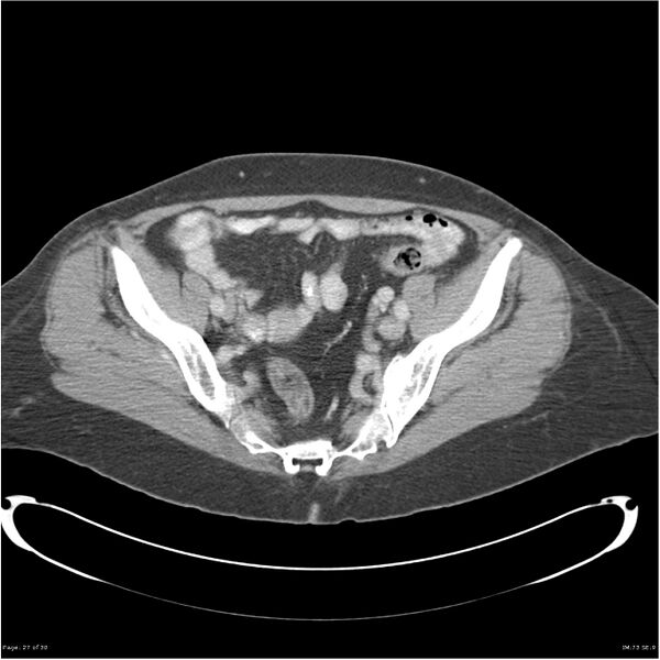 File:Carcinoid tumor of the ileum with metastasis to orbit (Radiopaedia 28165-28425 A 27).jpg