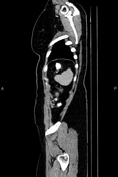 File:Carcinoma of uterine cervix (Radiopaedia 85861-101700 D 81).jpg