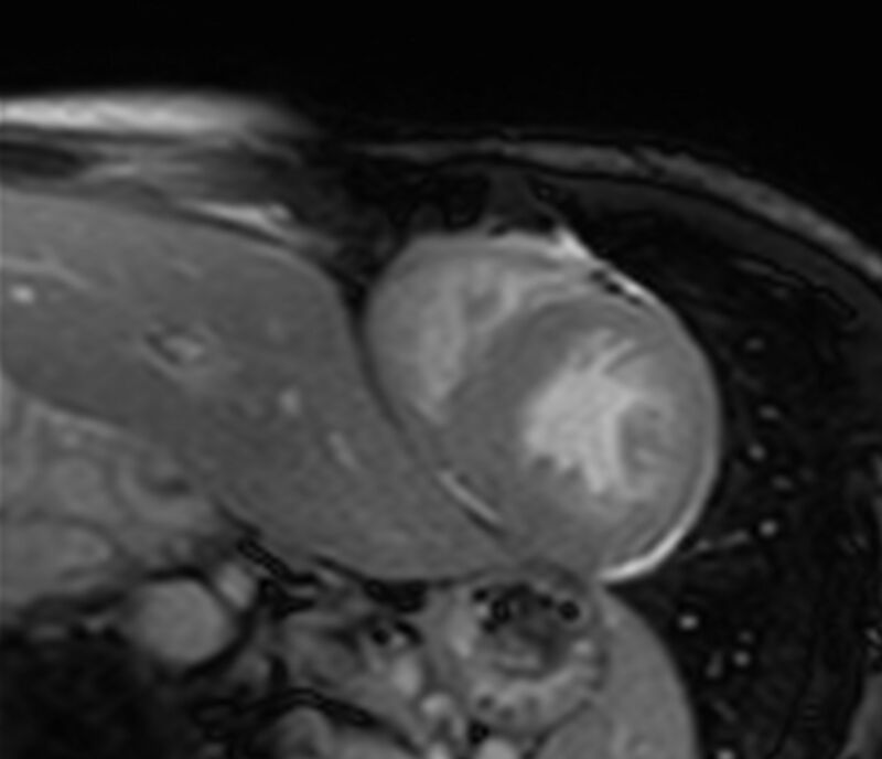 Cardiac amyloidosis (Radiopaedia 39736-42124 F 153).jpg