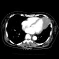 Cardiac fibroma (Radiopaedia 38974-41149 A 8).jpg