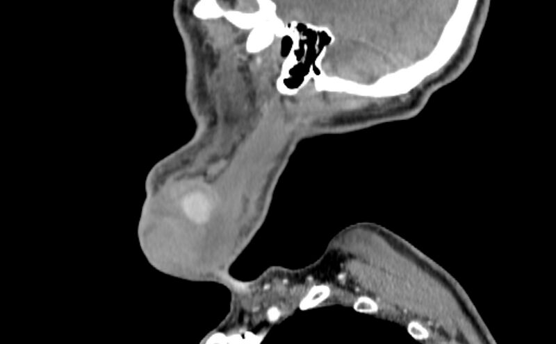 File:Carotid artery pseudoaneurysm (Radiopaedia 84030-99259 E 57).jpg