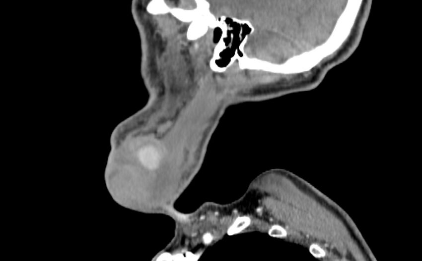 Carotid artery pseudoaneurysm (Radiopaedia 84030-99259 E 57).jpg