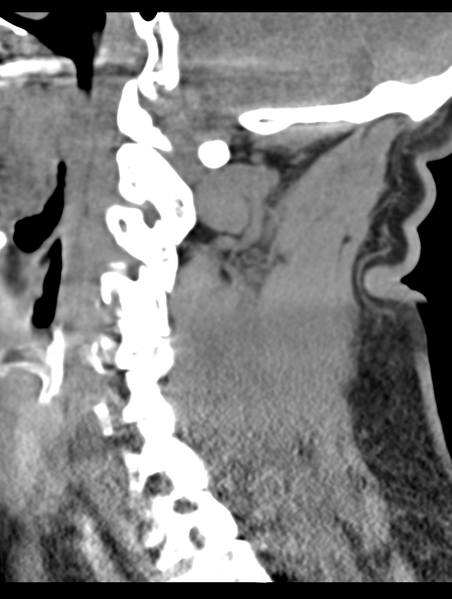 File:Cavernoma of cervical cord (Radiopaedia 50838-56346 B 32).png