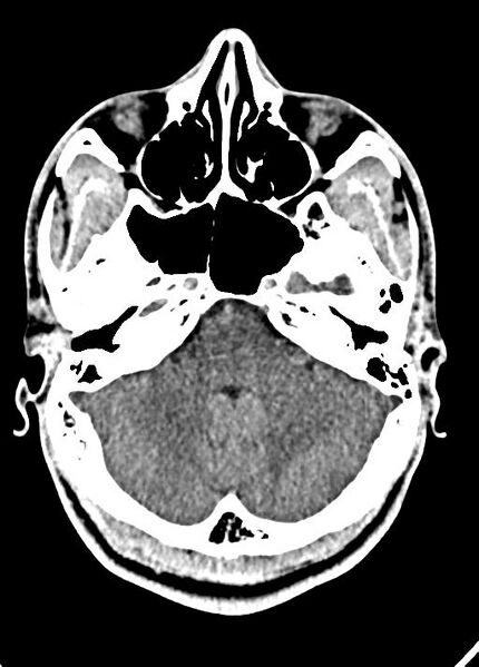 File:Cavum septum pellucidum and cavum vergae (Radiopaedia 77797-90060 Axial Brain Window 24).jpg