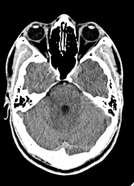 File:Cavum septum pellucidum and cavum vergae (Radiopaedia 77797-90060 Axial Brain Window 32).jpg